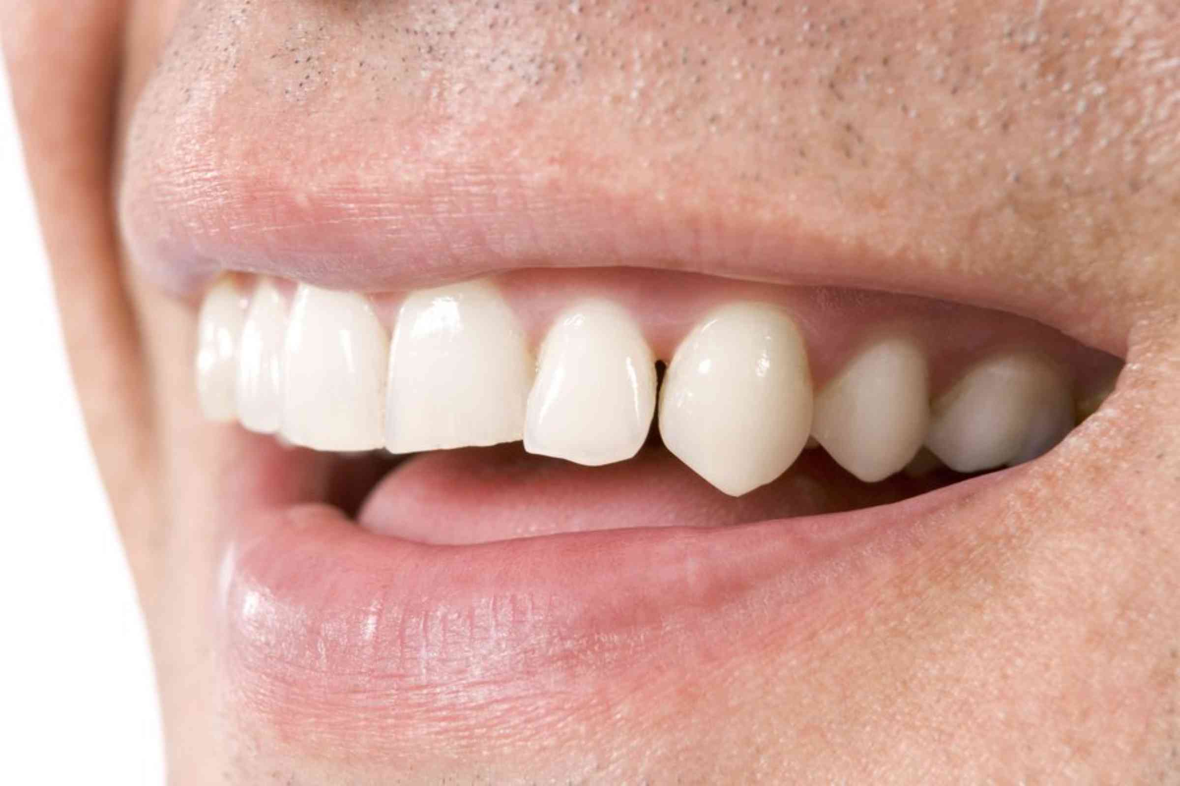 My Missing Teeth Can I get braces?