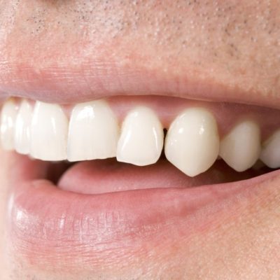 My Missing Teeth Ways to replace missing teeth