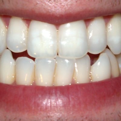My Missing Teeth Ways to replace missing teeth